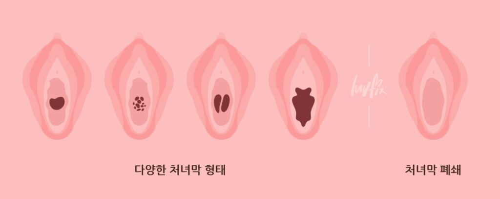 다양한 처녀막 형태를 보여주는 해부학적 일러스트로 첫경험 출혈이 개인마다 다르다는 사실을 설명하는 이미지